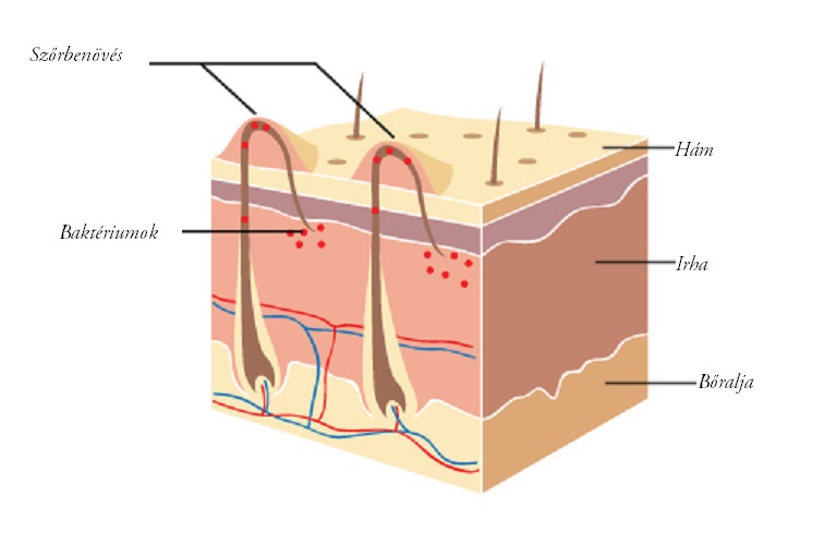 szőrbenövés kezelése szőrbenövés okai szőrbenövés intim helyen