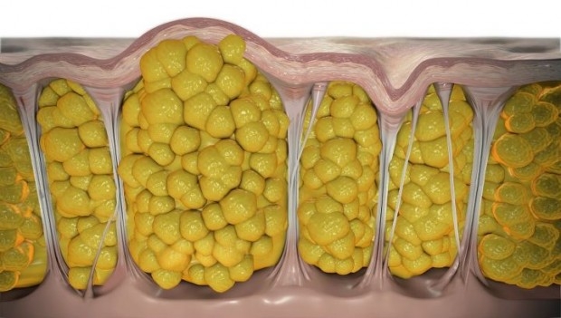 cellulite_narancsbőr